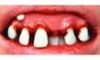 Picture of Sp. Offer - Billy Bob Teeth - Deliverance