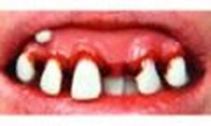 Picture of Sp. Offer - Billy Bob Teeth - Deliverance