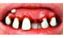 Picture of Sp. Offer - Billy Bob Teeth - Deliverance