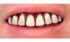 Picture of Sp. Offer - Billy Bob Teeth - Full Grill