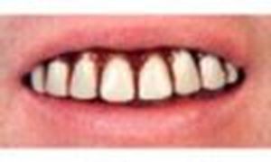 Picture of Sp. Offer - Billy Bob Teeth - Full Grill
